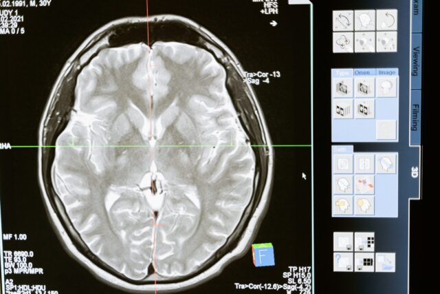 traumatic brain injury TBI auto accident fall